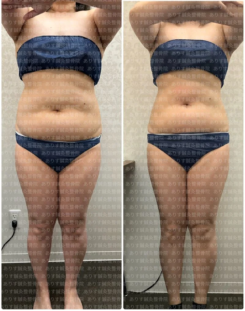 ウエスト－16㎝！！脂肪冷却で劇的変化！！～高松で短期間ダイエット
